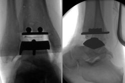 Intraoperative Röntgenbildverstärkerbilder