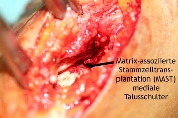 Matrix-assoziierte Stammzellentransplantation (MAST) mediale Talusschulter über posteromedialen Zugang