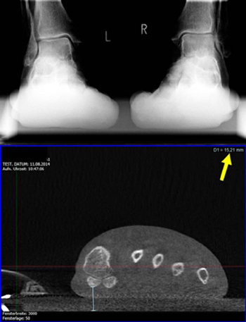 Vergleich der Abbildungsgenauigkeit zwischen Röntgen oben und Digitale Volumentomographie (DVT) PedCAT unten bei der Analyse des Großzehengrundgelenks, d.h. dem Metatarsale 1 und den Sesambeinen.