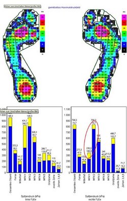 Deutliche Vergrößerung der Kontaktfläche der Mittelfußregion mit sehr hohem Maximaldruck und hoher Maximalkraft.