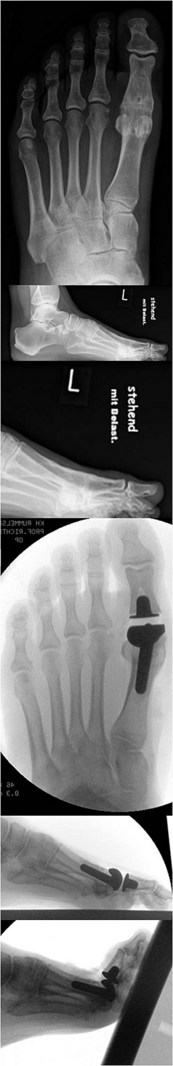 Fall mit persistierenden Beschwerden nach Arthrodese bei Hallux rigidus Grad 3.  Dabei bestand insbesondere ein erheblich gestörter Abrollvorgang trotz guter Stellung. Aus Studien ist bekannt, dass der Abrollvorgang vor allem in der präterminalen Standphase mit Versteifung wesentlich mehr beeinträchtigt ist als mit Prothese. Deshalb erfolgte in diesem Fall die AUfhebung der Arthrodese und die Implantation einer Rotoglide-Endoprothese.  Das unterste BIld zeigt die wiedererlangte Dorsalenxtension, die eine wesentliche Vorraussetzung für einen normalen Abrollvorgang ist.