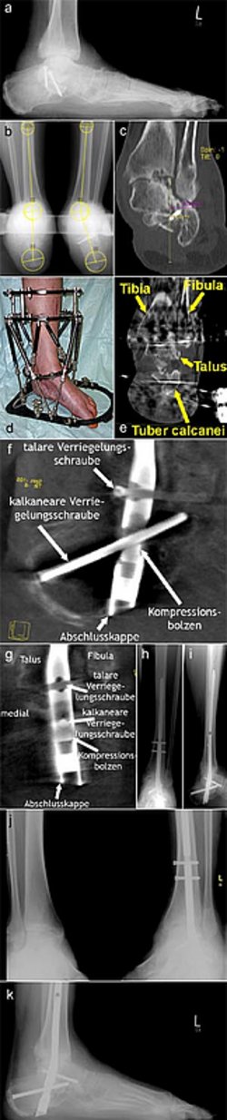 Bei dem Fall handelt es sich um beidseitige 3° offene Kalkaneusfrakturen, die in erheblicher Deformität ausgeheilt sind. Auf der mehr betroffenen und hier korrigierten linken Seite keine Belastbarkeit.