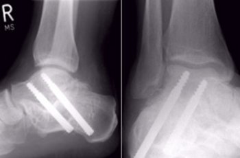 Navigierte Korrekturarthrodese Subtalargelenk und Fixierung mit Midfoot Fusion Bolt®