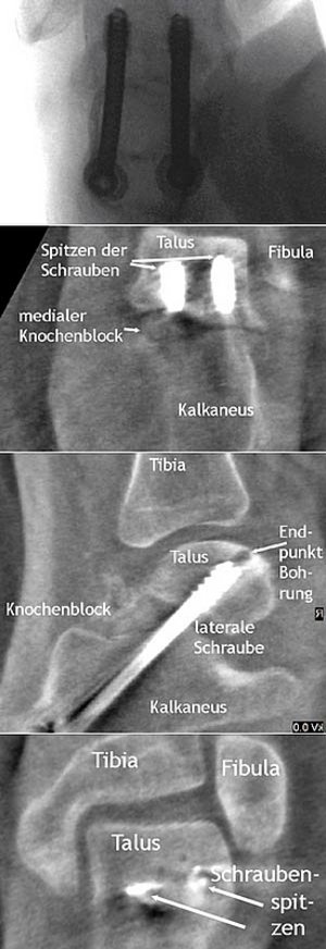 2D- und 3D-Bilder nach Nagelinsertion