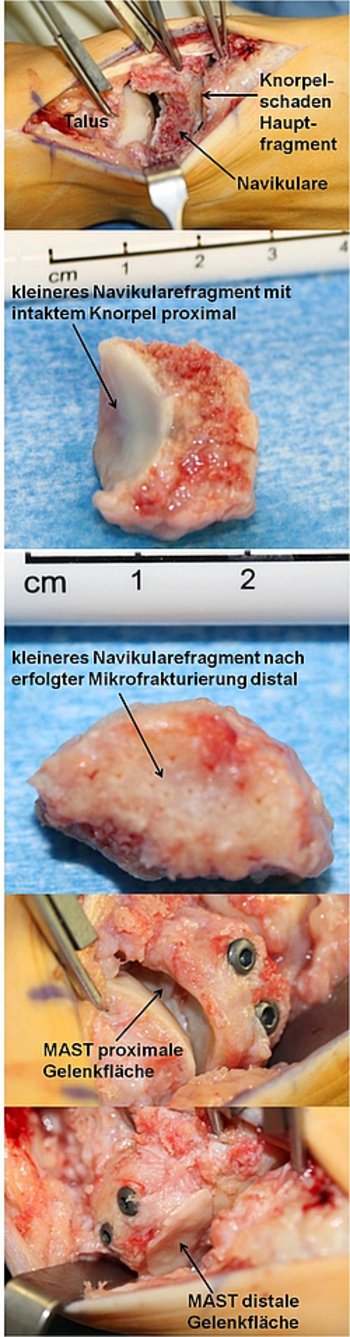 Matrix-assoziierte Stammzellentransplantation (MAST) am Naviculare bei viertgradigem Knorpelschaden bei veralteter Navicularefraktur.