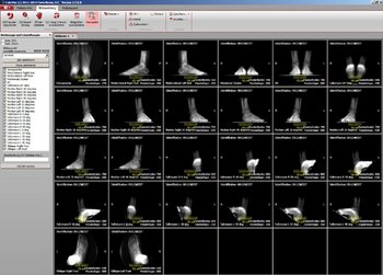 Abbildung Generierung von Röntgenbildern verschiedener Projektionen aus den Digitale Volumentomographie (DVT)-PedCAT-Daten