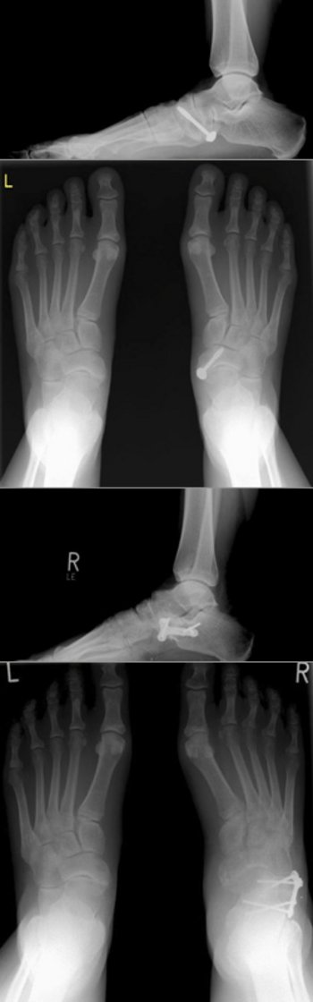 Gelenkerhaltende Korrektur eines Pes abductoplanovalgus mit Verlängerung des Kalkaneus, Verlagerung der Tibialis posterior Sehne und Verstärkung mit der Flexor digitorum longus Sehne.