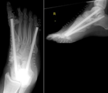 Postoperative Bilder mit 2 Midfoot Fusion Bolts®, retrograd Metatarsale 1 – Kuboid 1 – Navikulare – Talus und retrograd Metatarsale 5 – Kuboid – Kalkaneus.