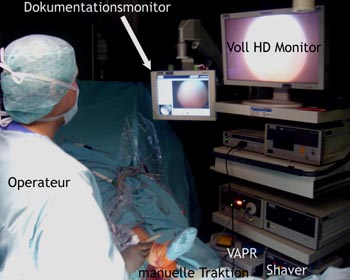 Arthroskopieturm mit "Voll-HD"-Technik, Dokumentationssystem, Shaver und VAPR® und Einsatz der manuellen Traktion.