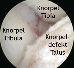 Schwerer Knorpelschaden