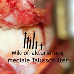 Mikrofrakturierung an der lateralen Talusschulter.