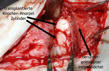 Knochen-Knorpel-Transplantation