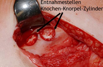 Knochen-Knorpel-Transplantation
