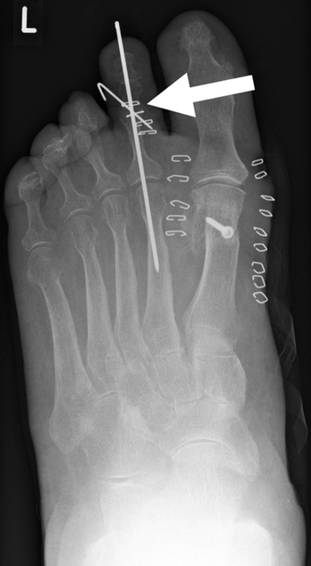 Arthrodese des proximalen Interphalangealgelenkes der 2. Zehe