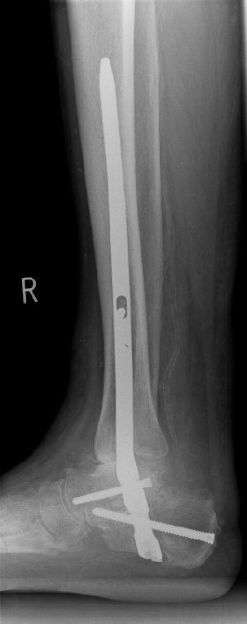 Arthrodese des oberen und unteren Sprunggelenks (OSG+USG) mittels A3-Nagels