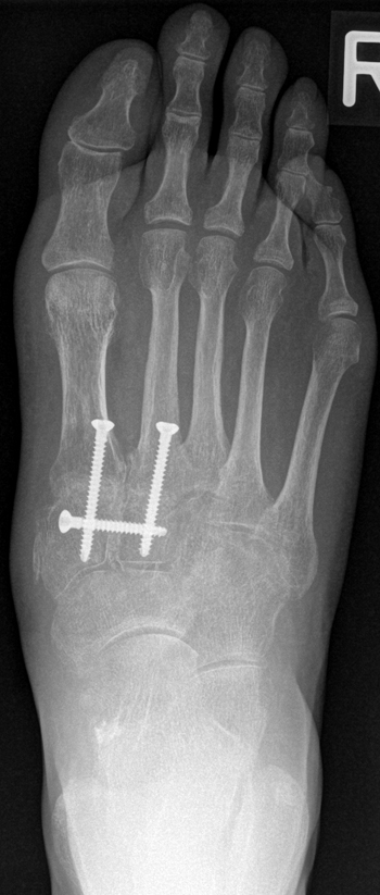 Arthrodese des Tarso-Metatarsale 1 und 2-Gelenks und des Intercuneiforme-1-2-Gelenkes