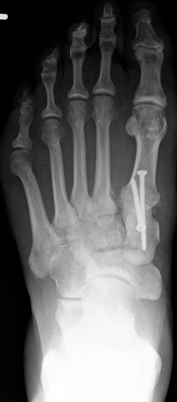 Arthrodese des Tarso-Metatarsale 1-Gelenks (TMT 1)