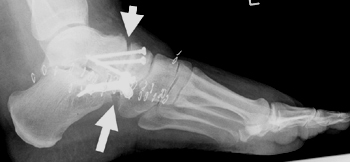 Arthrodese Talonaviculargelenks (oberer Pfeil) und des Calcaneocuboidgelenks (unterer Pfeil), d.h. sog. Double-Arthrodese