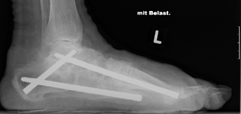 Panarthrodese des Fußes