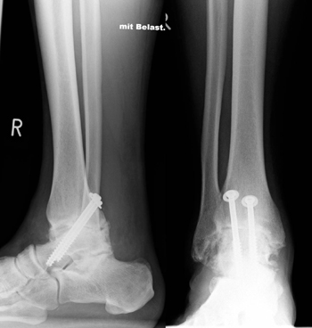 Versteifung/Arthrodese des oberen Sprunggelenks (OSG).