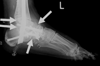 Arthrodese des oberen und unteren Sprunggelenks und des Talonavicular- und Calcaneocuboidgelenks