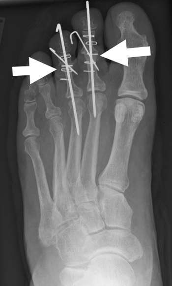 Arthrodese des proximalen Interphalangealgelenkes der 2. und 3. Zehe