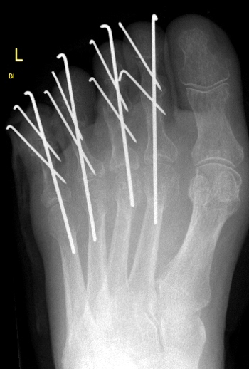 Arthrodese des proximalen und distalen Interphalangealgelenkes der 2. - 5. Zehe