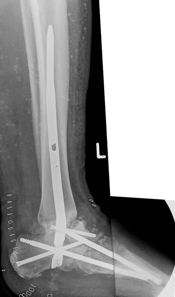 Panarthrodese inkl. oberes Sprunggelenk d.h. 16 Gelenke.