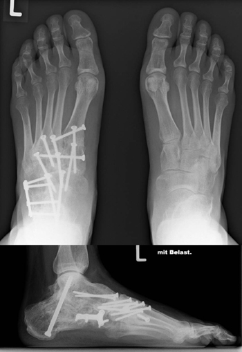 Arthrodese 