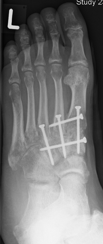 Arthrodese der Tarso-Metatarsale 1- bis 3-Gelenke (TMT 1-3) und Intercuneiforme 1/2- und 2/3 gelenke (IC 1/2 + 2/3)