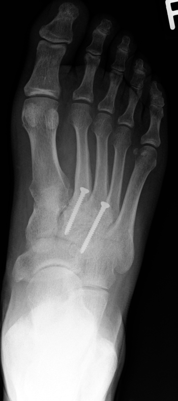 Arthrodese der Tarso-Metatarsale 2- und 3-Gelenke