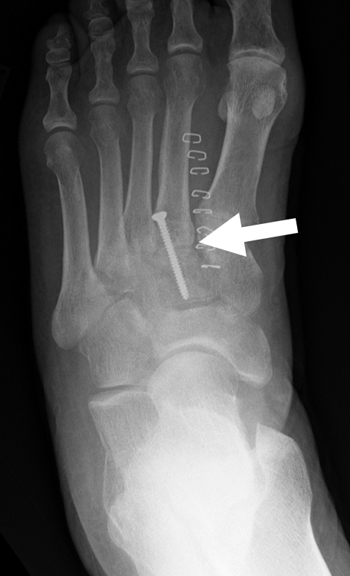 Arthrodese des Tarso-Metatarsale 2-Gelenks (TMT 2)