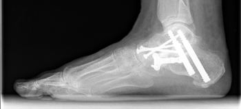 Arthrodese des unteren Sprunggelenks (USG), des Talonaviculargelenks und des Calcaneocuboidgelenks, d.h. sog. Triple-Arthrodese