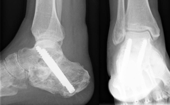 Arthrodese des unteren Sprunggelenks (USG)