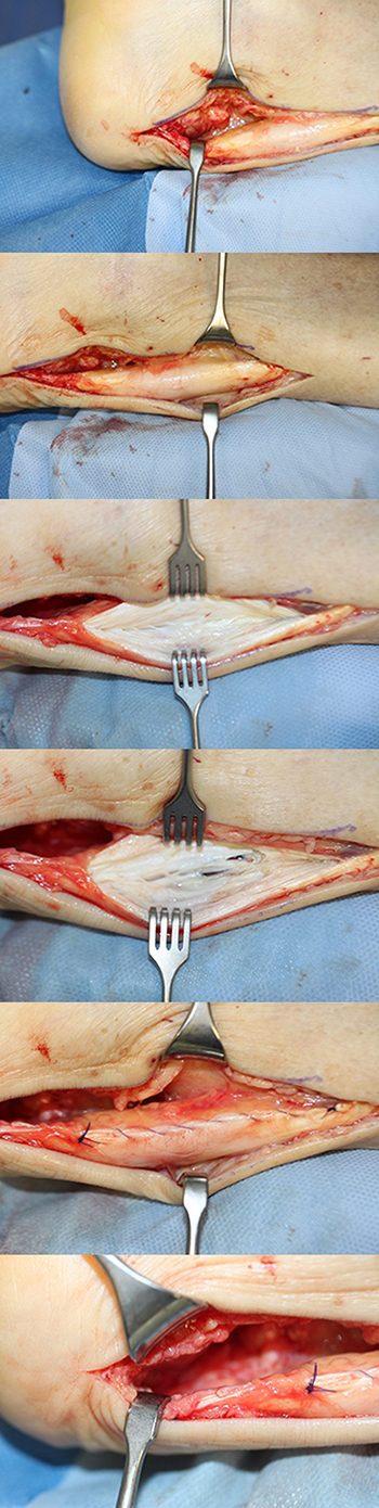 Abtragung Haglunddeformität und Debridement bei Achillodynie