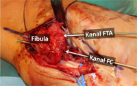 Kanäle zur fibularen Insertion des Ligamentum fibulotalare anterius (FTA) und des Ligamentum fibulocalcaneare (FC).