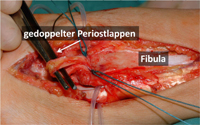 Dopplung und Insertion des Periostlappens.