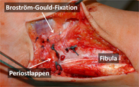 Rekonstruktionsergebnis mit Broström-Gould-Prozedur mit Fixierung des Strecksehnenretinakulums an die Vorderseite der distalen Fibula