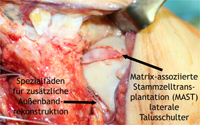 Komplexe Außenbandrekonstruktion mit zusätzlicher Matrix-assoziierte Stammzellentransplantation (MAST) laterale Talusschulter.