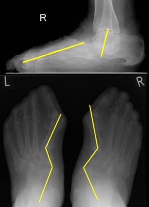 Präoperative Röntgenbilder mit Belastung welche einen schweren Plattfuß zeigen
