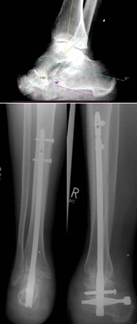 Ulkusbildung am Stumpf distal-plantar nach auswärtiger Amputation im Mittelfußbereich.