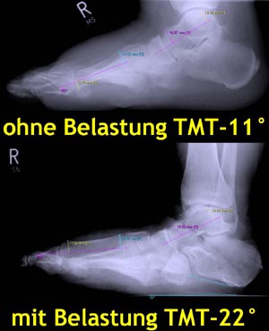Vergleich Röntgen mit und ohne Belastung mit deutlich unterschiedlichem Talo-Metatarsale-1-Winkel (TMT).