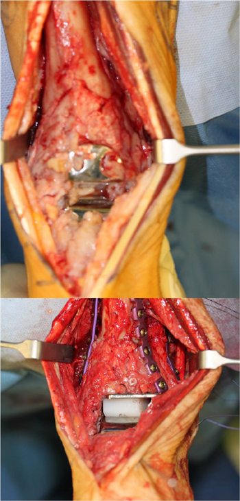 Intraoperativer Darstellung der Deformität bei einliegender HINTEGRA-Prothese (oben) und intraoperativer Situs nach Korrektur der Deformität und Prothesenwechsel (STAR) (unten).