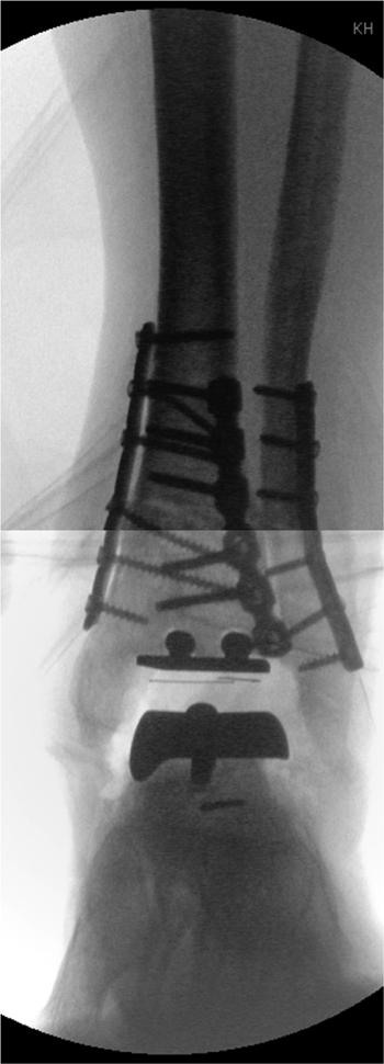 Röntgenbildverstärkerbilder mit optimaler Ausrichtung der Knochenachse und Endoprothese (STAR) bei sehr guter Beweglichkeit (s. weiter unten).