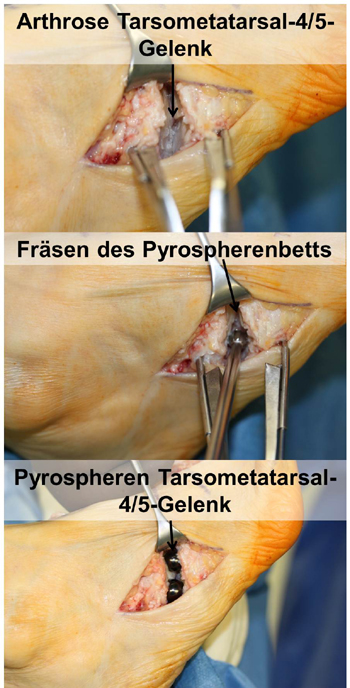 Implantation von Pyrospheren