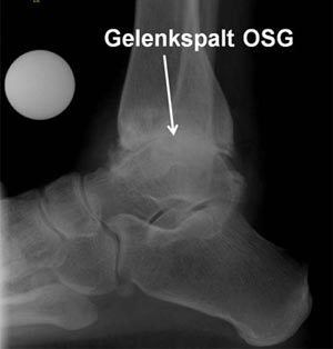 Schwere Arthrose des oberen Sprunggelenks