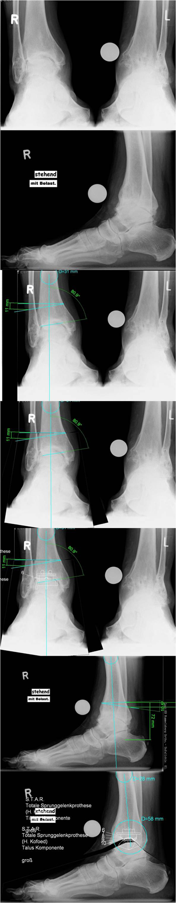 Fall mit posttraumatischer Arthrose am OSG