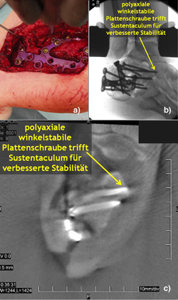 Offene Reposition und Plattenosteosynthese einer Kalkaneusfraktur über einen erweiterten lateral Zugang