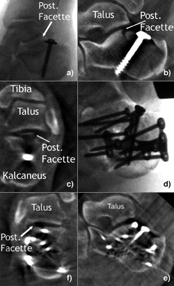 Zunächst geschlossene und später offene Reposition und interne Fixation einer Kalkaneusfraktur.