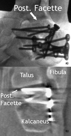 Offene Reposition über erweiterten lateralen Standardzugang und interne Fixation mit Plattenosteosynthese einer Kalkaneusfraktur